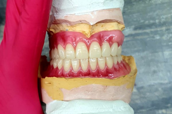 دندان مصنوعی طرح لبخند